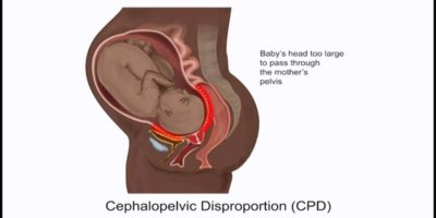 cephalo pelvic disproportion 