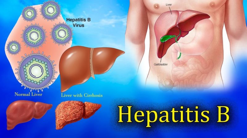 Hepatitis B