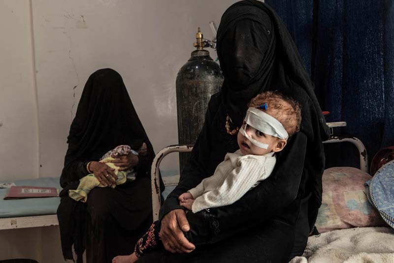 Malnutrition-cholera-Yemen-woes-1