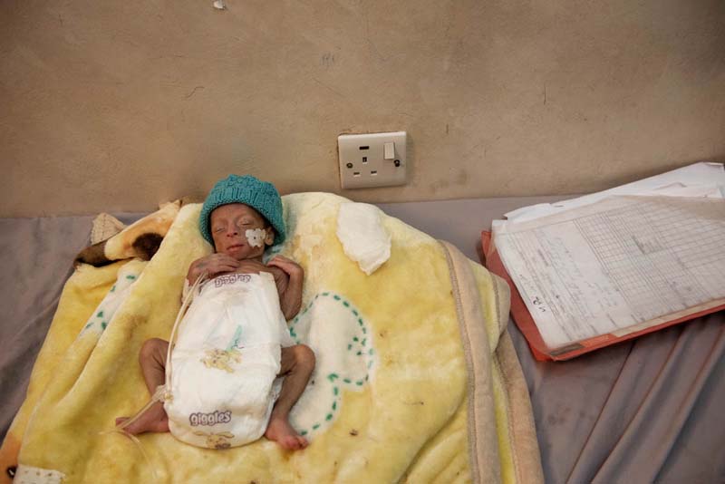 Malnutrition-cholera-Yemen-woes