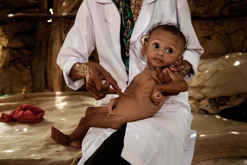 Malnutrition-cholera-Yemen-woes