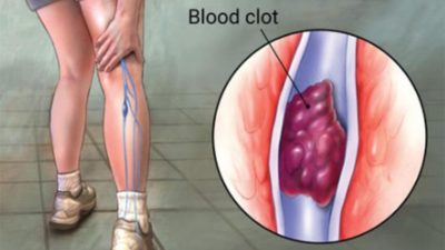 Deep vein thrombosis
