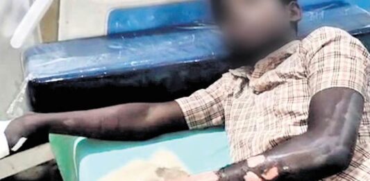 திருப்பூர்: சாதி வெறியால் சிறுவன் தீயில் வீசப்பட்ட கொடூரம்!